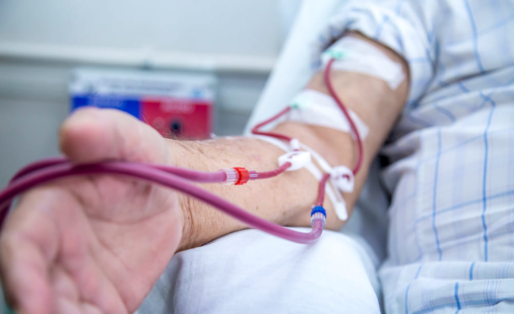 Creación de fistulas para hemodiálisis en Guadalajara, Jal.