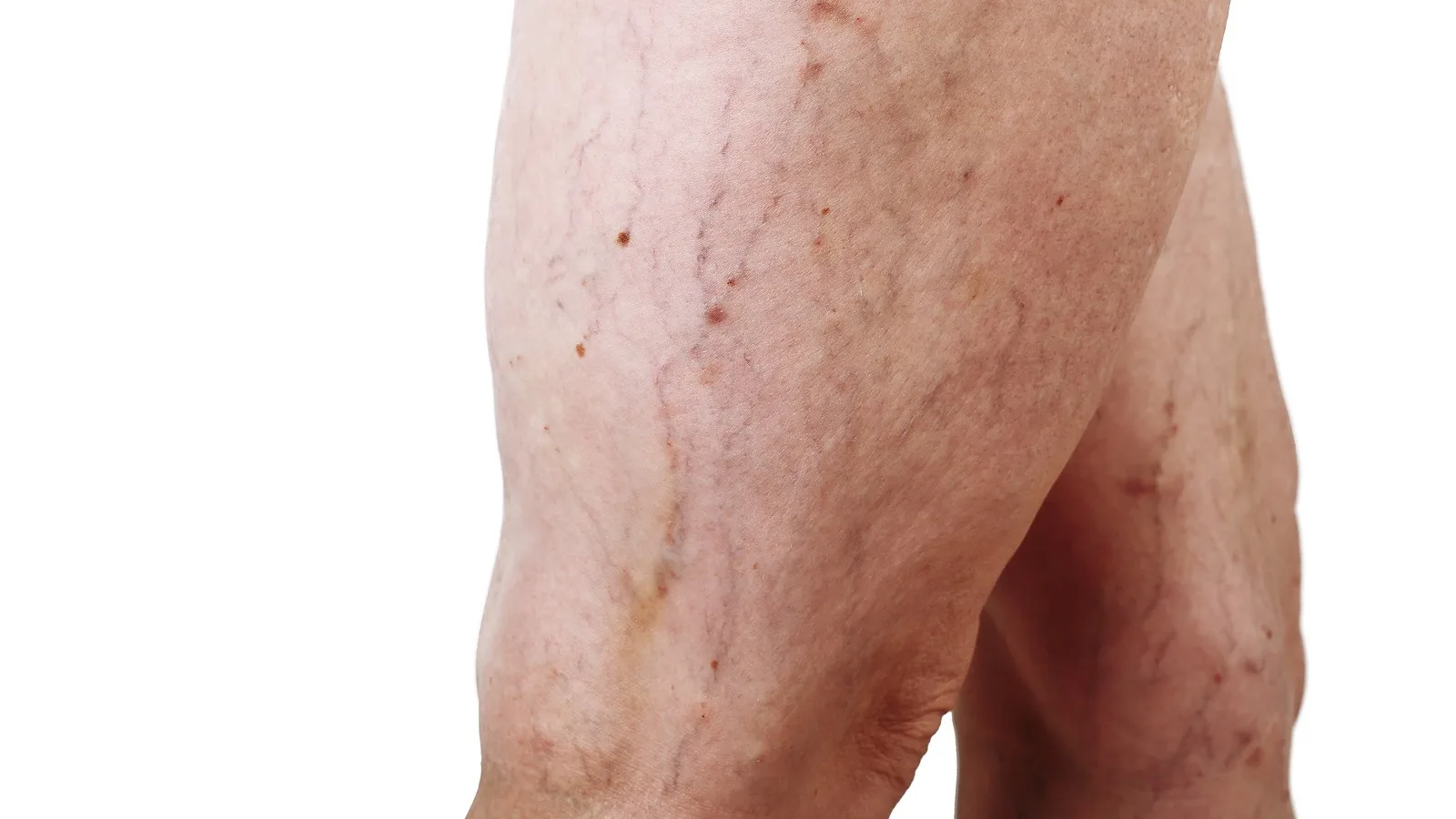 Especialistas en el tratamiento de edema en piernas en Guadalajara