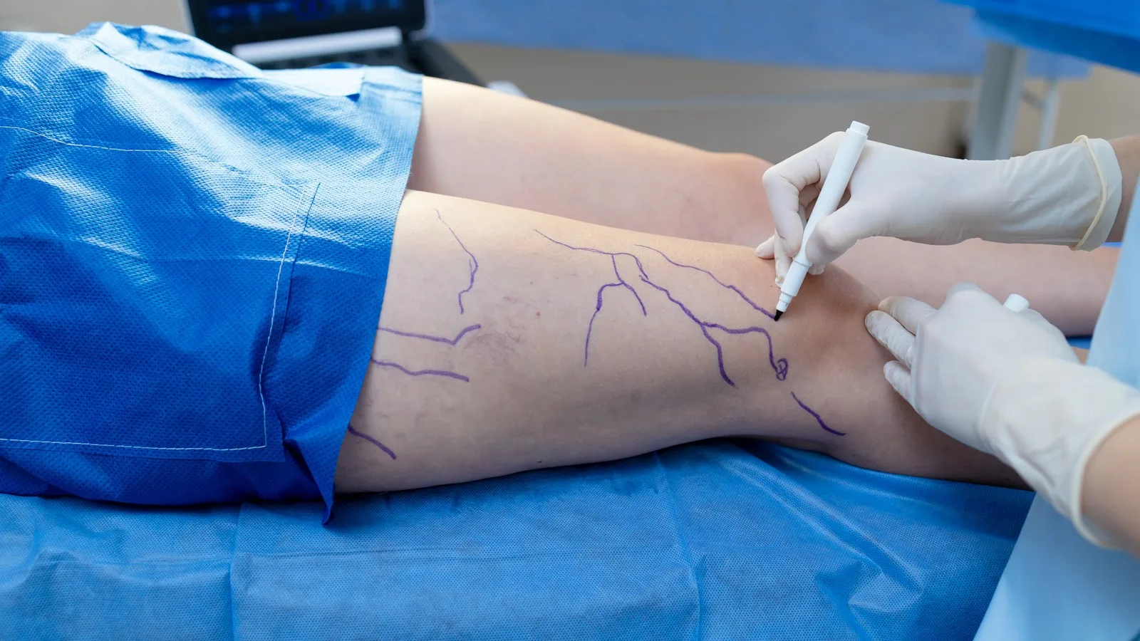 ¿Qué médico trata síndrome postrombótico?