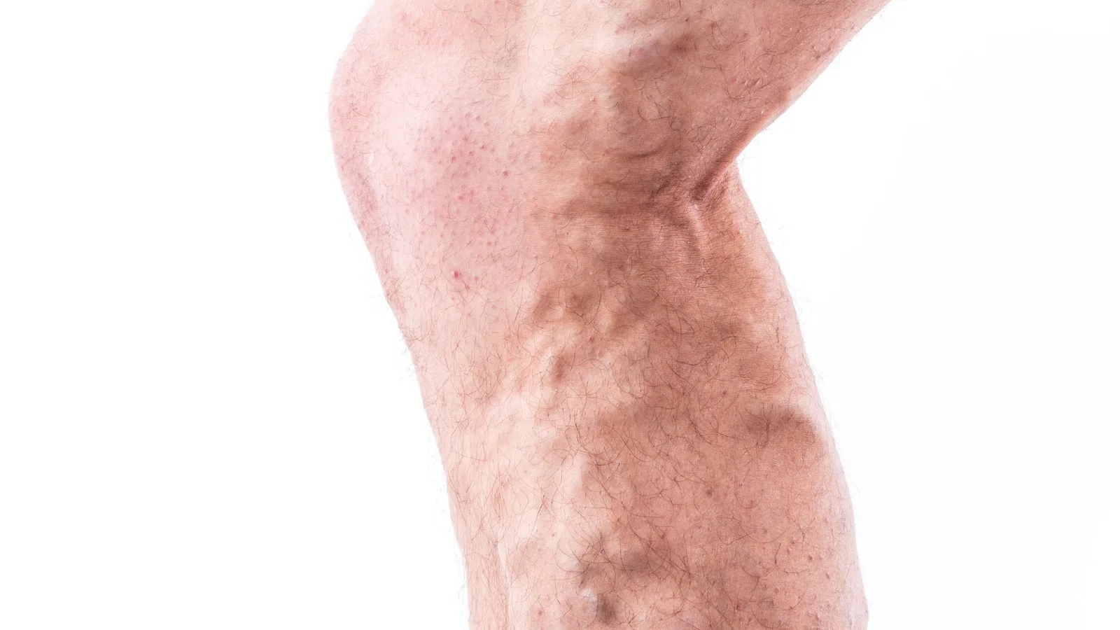 Especialista en tromboflebitis en Guadalajara