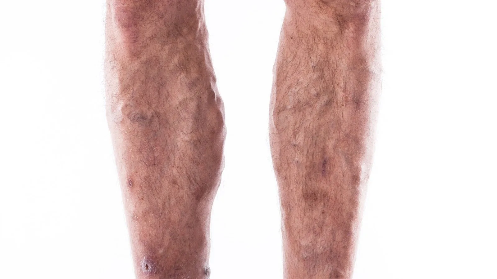 ¿Qué médico trata tromboflebitis en Guadalajara?