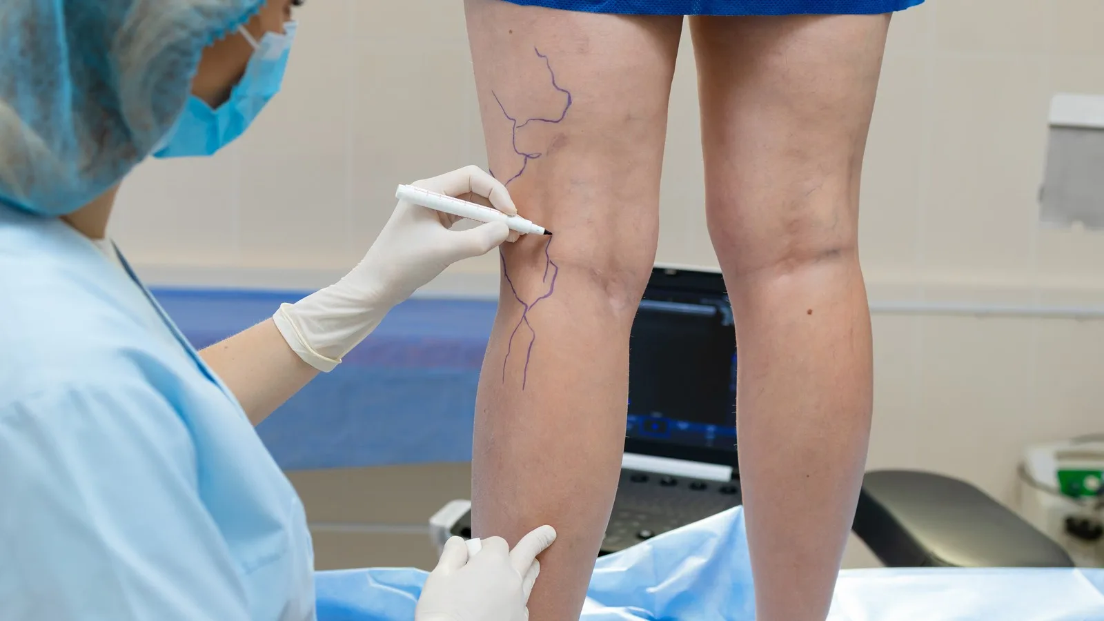 ¿Qué médico trata varices?